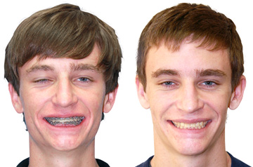 Коррекция прикуса и асимметрии лица до и после ортогнатической операции фото пациента в анфас с улыбкой