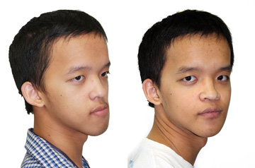 Коррекция лицевой асимметрии пациента до и после ортогнатической операции в три-четверти оборота без улыбки