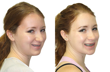 Исправление прикуса, увеличение дыхательных путей, фото пациента до и после ортогнатической операции в три-четверти оборота лица с улыбкой
