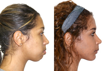Реконструкция лицевого скелета до и после ортогнатической операции фото пациента в профиль без улыбки губы вместе