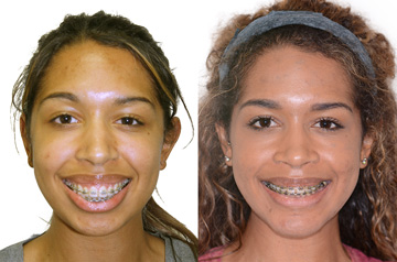 Реконструкция лицевого скелета до и после ортогнатической операции фото пациента в анфас с улыбкой