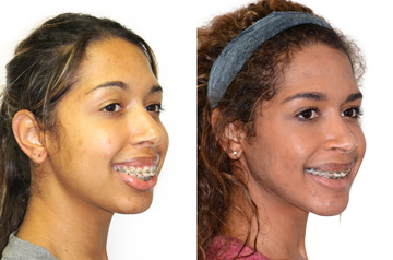 Реконструкция лицевого скелета до и после ортогнатической операции фото пациента в три-четверти оборота с улыбкой