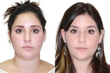 Исправление неправильного прикуса и коррекция лицевой асимметрии до и после операции в анфас без улыбки