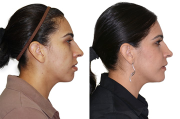 Коррекция прикуса и лицевой ассиметрии фото пациентки до и после ортогнатической операции в профиль с расслабленными губами