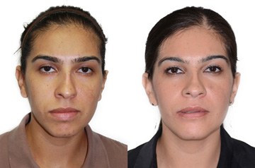 Коррекция прикуса и лицевой ассиметрии фото пациентки до и после ортогнатической операции в анфас без улыбки