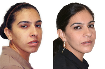Коррекция прикуса и лицевой ассиметрии фото пациентки до и после ортогнатической операции в три-четверти оборота лица без улыбки