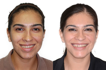 Коррекция прикуса и лицевой ассиметрии фото пациентки до и после ортогнатической операции в анфас с улыбкой