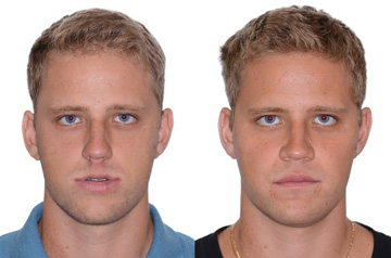 Фото пациента до и после ортогнатической операции в анфас без улыбки
