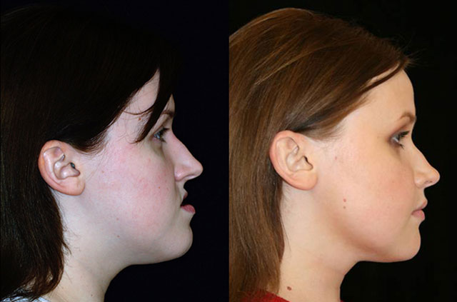 Corrective jaw surgery and bite correction profile view no smile