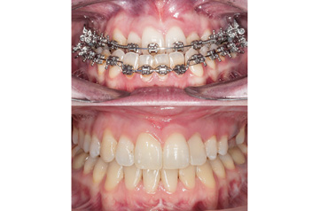 Corrective jaw surgery and bite correction front view with smile