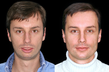 Коррекция прикуса за счет остеотомии при ортогнатической операции фото пациента до и после в анфас без улыбки