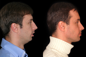 Коррекция прикуса за счет остеотомии при ортогнатической операции фото пациента до и после в профиль без улыбки
