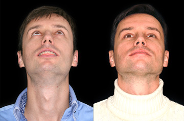 Коррекция прикуса за счет остеотомии при ортогнатической операции фото пациента до и после подбородок вверх