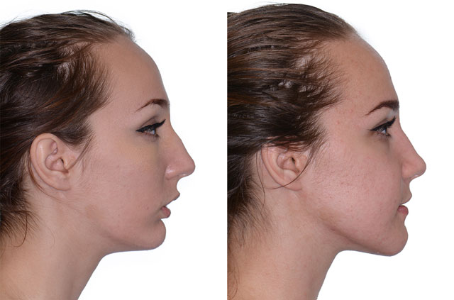Ортогнатическая операция, фото До и После в профиль, губы расслаблены