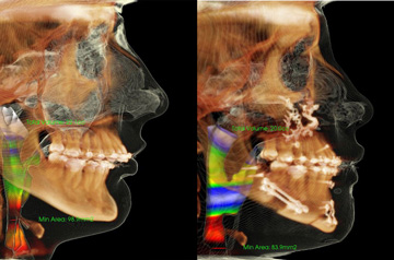 Компьютерная томограмма до и после ортогнатической операции