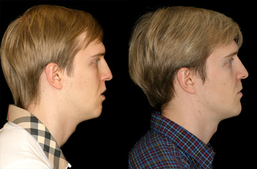 Остеотомия верхней и нижней челюсти, фронтальное фото До и После, губы расслаблены