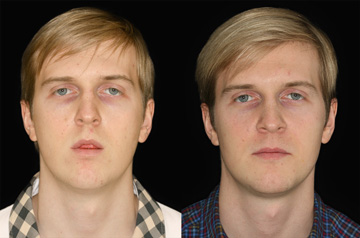 Остеотомия верхней и нижней челюсти, фото До и После в профиль, губы расслаблены