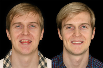 Остеотомия верхней и нижней челюсти, фронтальное фото До и После с улыбкой