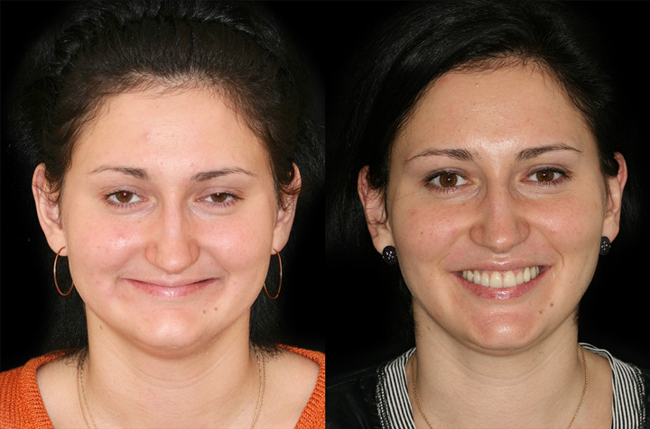 Ортогнатическое хирургическое вмешательство, фронтальное фото До и После с улыбкой
