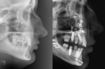 Компьютерная томограмма пациента до и после ортогнатической операции