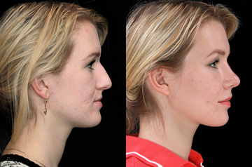 Контурирование тела нижней челюсти, фото пациента До и После в профиль губы вместе
