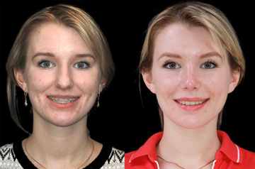Контурирование тела нижней челюсти, фото пациента До и После в анфас с улыбкой