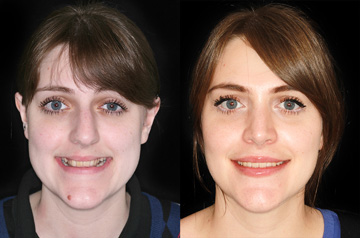 Коррекция открытого прикуса, фронтальное фото пациента До и После с улыбкой