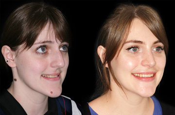 Коррекция открытого прикуса, фото До и После в три четверти оборота лица с улыбкой
