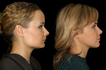 Коррекция открытого прикуса, фото пациента До и После в профиль губы вместе