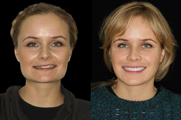 Коррекция открытого прикуса, фронтальное фото пациента До и После с улыбкой