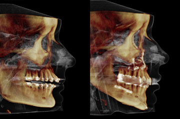 Компьютерная томограмма пациента до и после ортогнатической операции