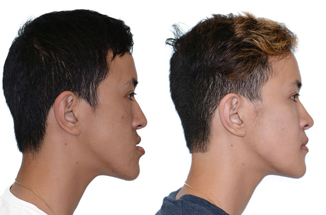 Коррекция открытого прикуса, фото пациента До и После в профиль губы вместе