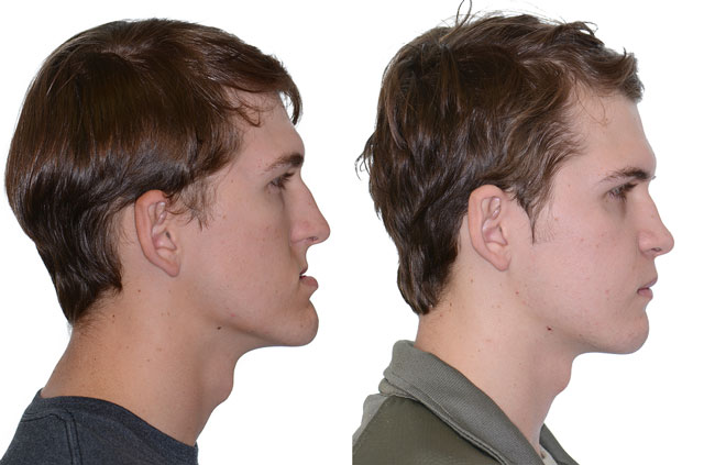 Коррекция лицевого скелета, фото пациента До и После в профиль губы вместе
