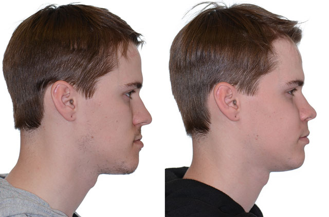 Коррекция лицевого скелета, фото пациента До и После в профиль губы вместе