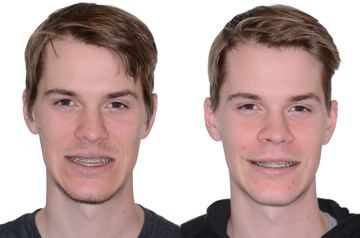 Коррекция лицевого скелета, фронтальное фото До и После с улыбкой