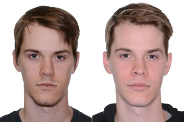 Коррекция лицевого скелета, фото пациента в три-четверти оборота До и После без улыбки