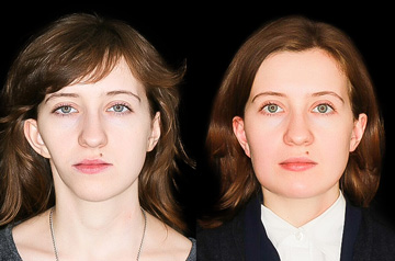Коррекция асимметрии лица, фото пациента До и После в анфас