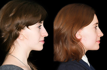 Коррекция асимметрии лица, фото пациента До и После в профиль
