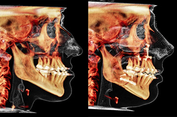 Компьютерная томография пациента до и после ортогнатической операции проведенной в клинике Фэйс Смайл центр