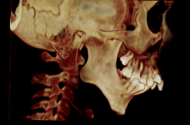 Компьютерная томография пациента до протезирования сустава