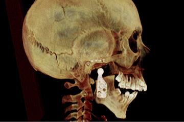 Компьютерная томография пациента после протезирования сустава