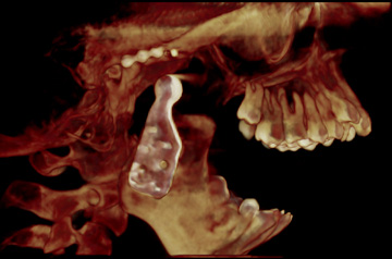 Компьютерная томография до протезирования сустава рот открыт
