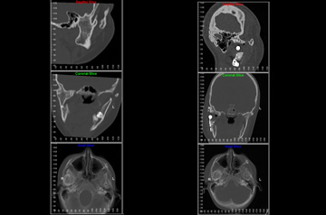 Компьютерная томография до и после протезирования сустава