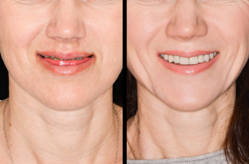 Коррекция прикуса, фото пациента До и После в анфас с улыбкой