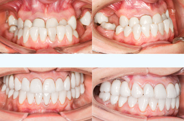Коррекция прикуса, фото зубов До и После
