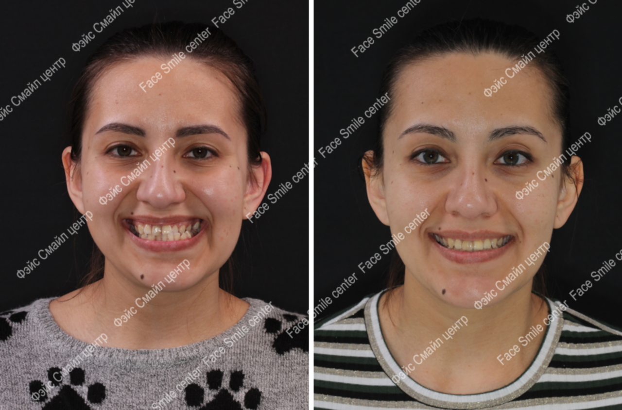 Коррекция скелетного открытого прикуса, фото пациента До и После в анфас без улыбки