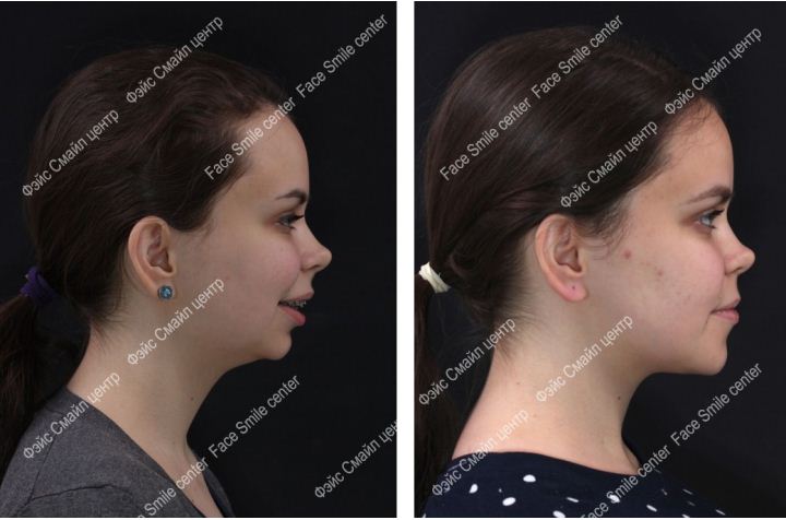 Коррекция скелетного открытого прикуса, фото пациента До и После в профиль без улыбки