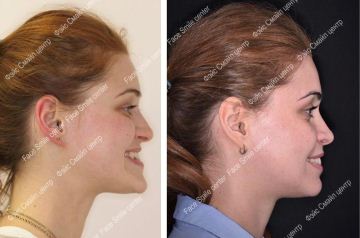 Коррекция скелетного открытого прикуса, фото До и После в 3/4 с улыбкой