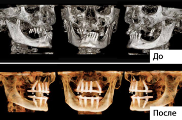 Тотальная мплантация и протезирование зубов все на четырех фото до и после