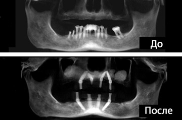 Рентгеновские снимки до и после имплантации все на четырех